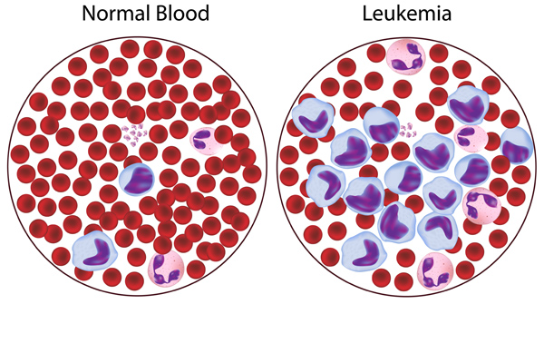 case study about leukemia